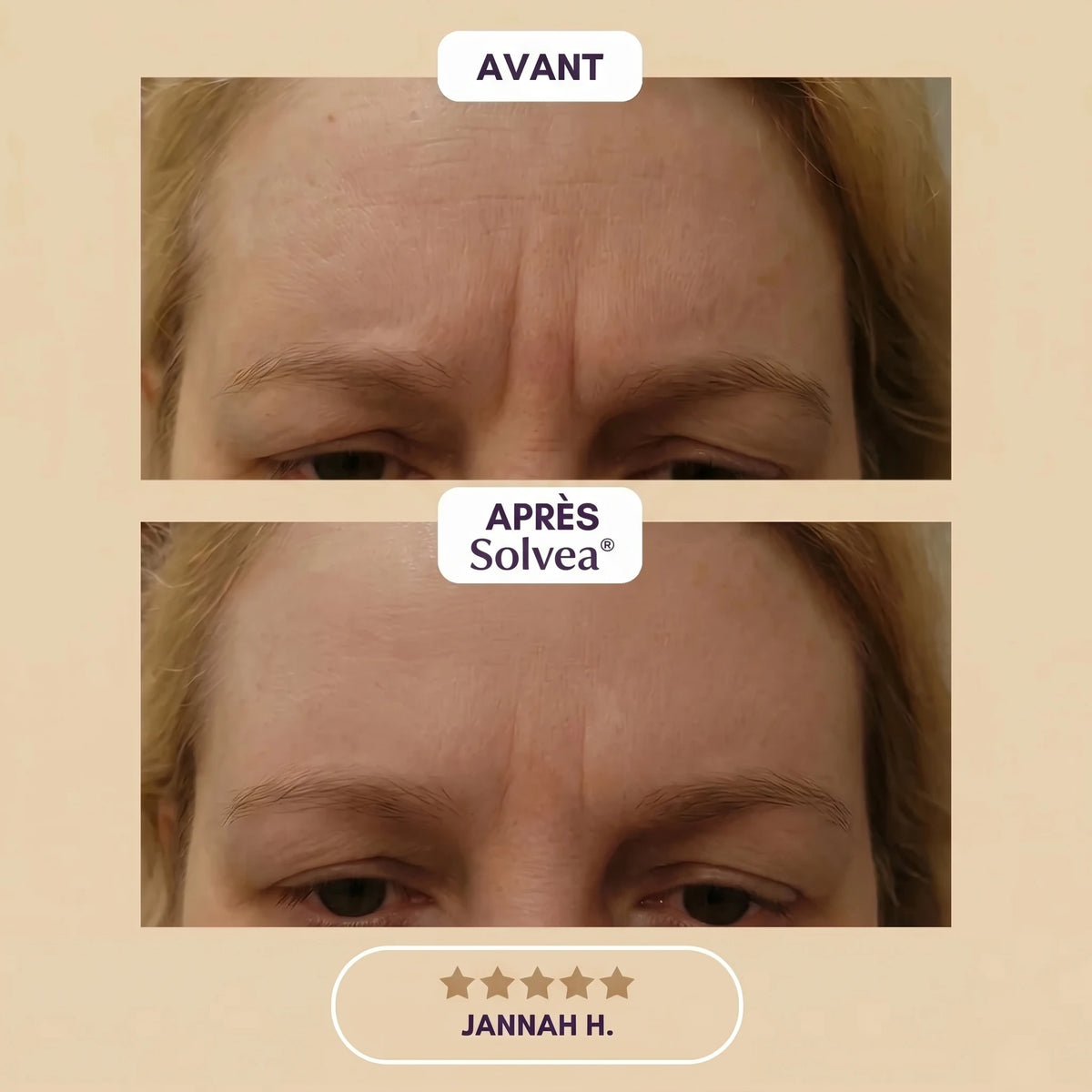 Solvea – Silicone Lift Patches