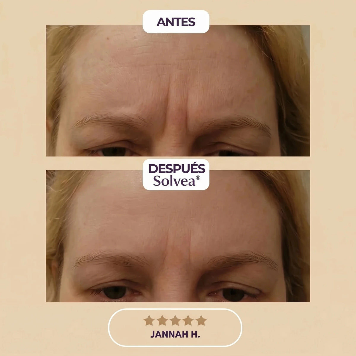 Solvéa – Silicone Lift Patches