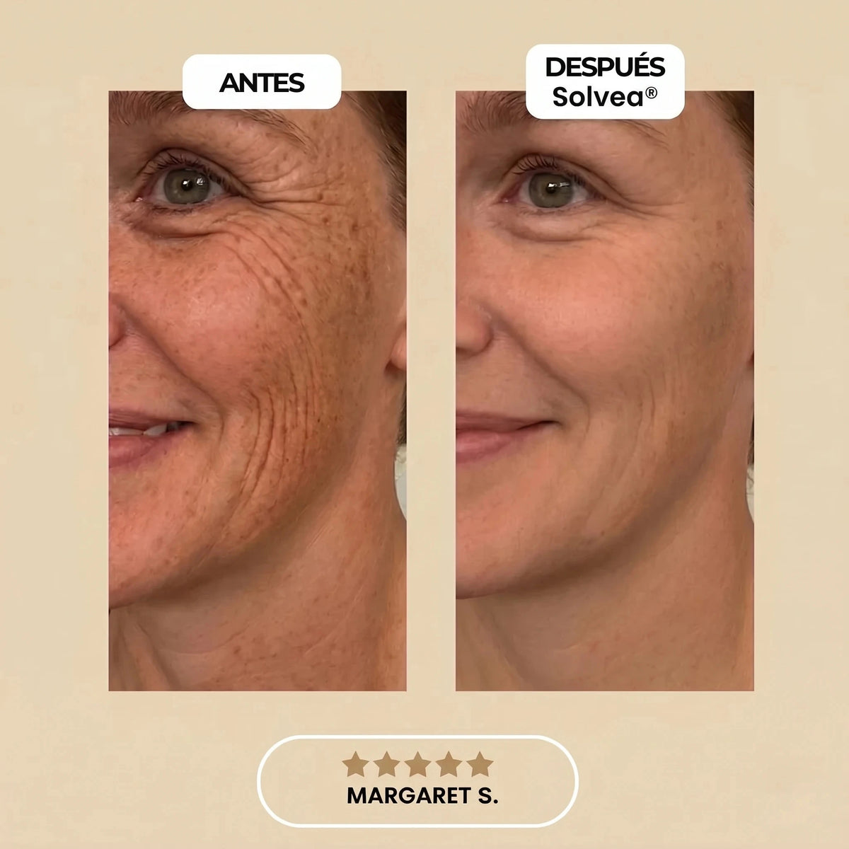 Solvéa – Silicone Lift Patches